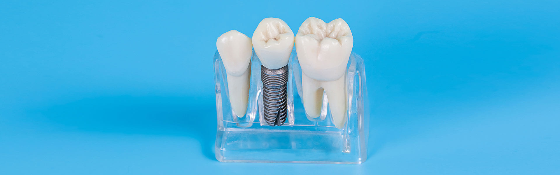 Comprehensive Guide to Dental Implant Surgery: What You Need to Know